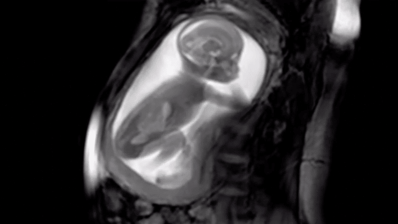 Baby MRI scan
