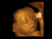 20-week abortions hit 15,000 in five years