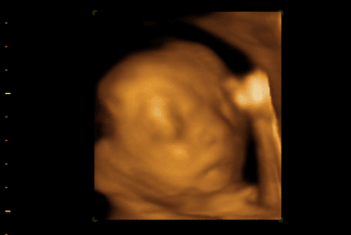 20-week abortions hit 15,000 in five years