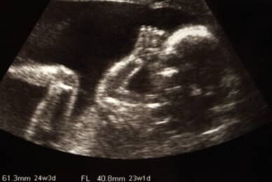 Abortion decriminalisation options considered by doctors’ union