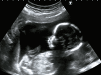 US abortionists launch lawsuit to overturn law protecting unborn