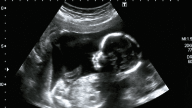 Baby scan