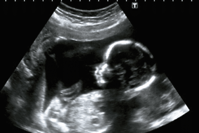 Two unborn children aborted in Ireland due to misdiagnosis
