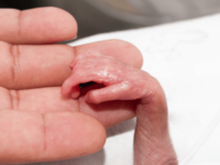 Baby born with hands smaller than a penny returns home