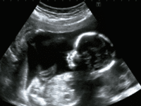 Teen: ‘Seeing an ultrasound of my twins turned me from abortion’