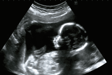 Teen: ‘Seeing an ultrasound of my twins turned me from abortion’