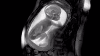 MRI scan of baby in womb