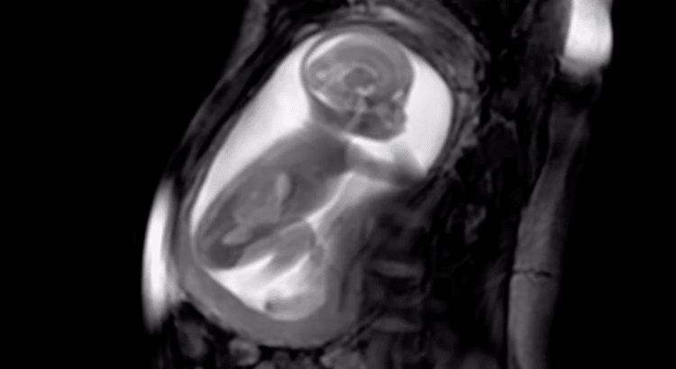 MRI scan of baby in womb