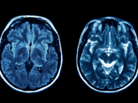 Ethical stem cell research points to potential stroke and dementia treatment