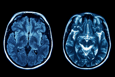 Ethical stem cell research points to potential stroke and dementia treatment